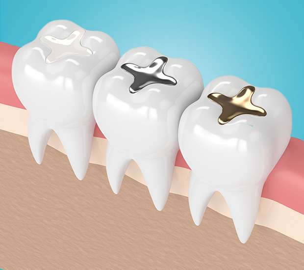 Gilbert Composite Fillings