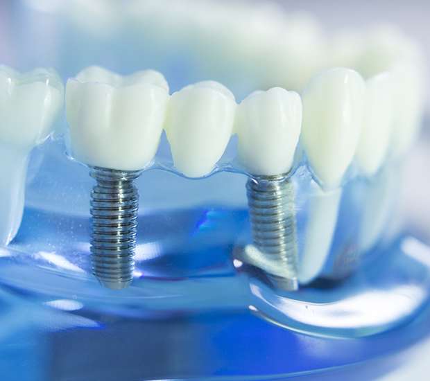 Gilbert Dental Implants