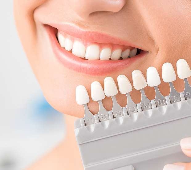 Gilbert Dental Veneers and Dental Laminates